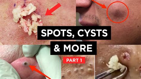 new pimple popping videos 2023